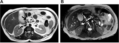 Synchronous Periampullary Tumors in a Patient With Pancreas Divisum and Neurofibromatosis Type 1